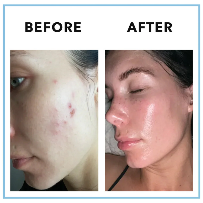 Mindbodyskin Hormonal Acne Supplement